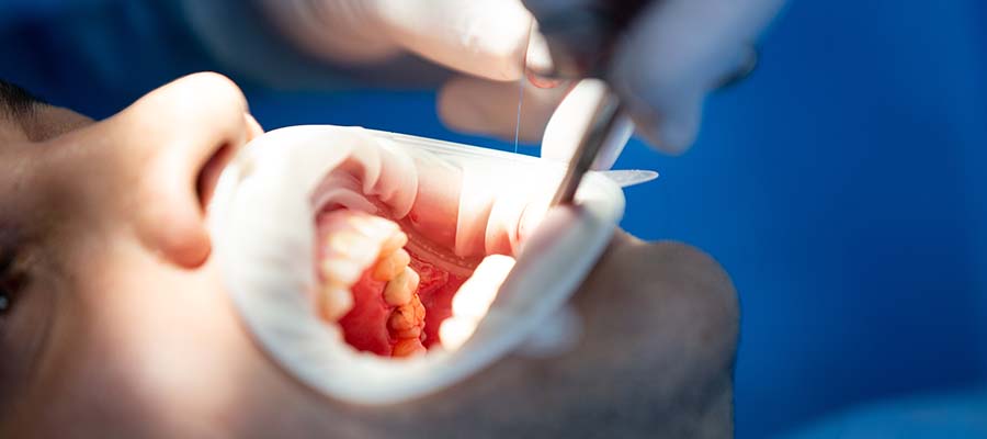 ציפוי שיניים